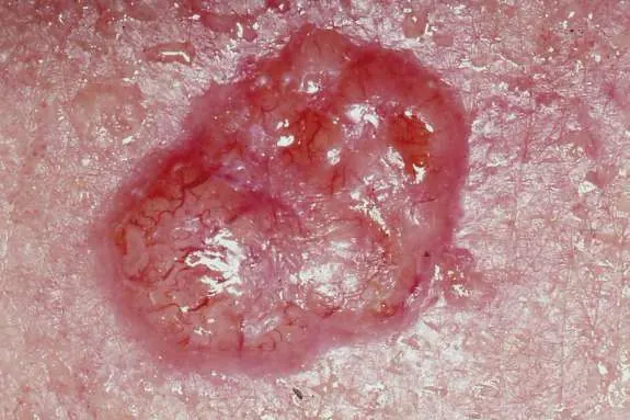 An mRNA Vaccine Just Shrank the Deadliest Childhood Cancer by 70%